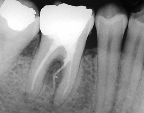 Perforations Radiculaires : Prévention, Détection et Réparation