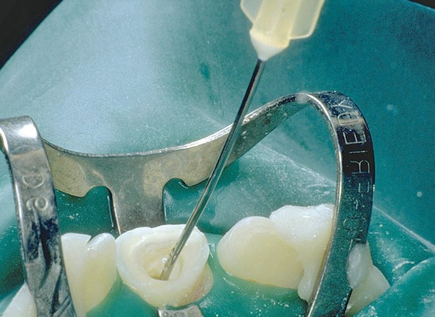 Endodontic Irrigation Pertot W.J. & Simon S. — Complete Guide