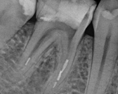 Gestion des instruments fracturés en endodontie : recommandations cliniques.
